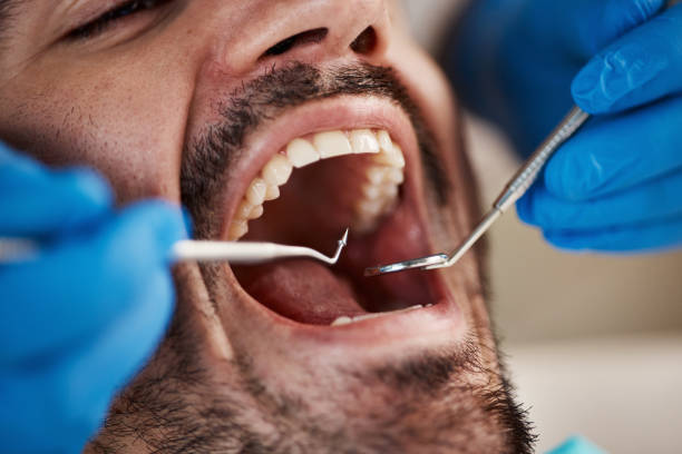 Best Emergency Dentist for Knocked-Out Tooth in Micco, FL