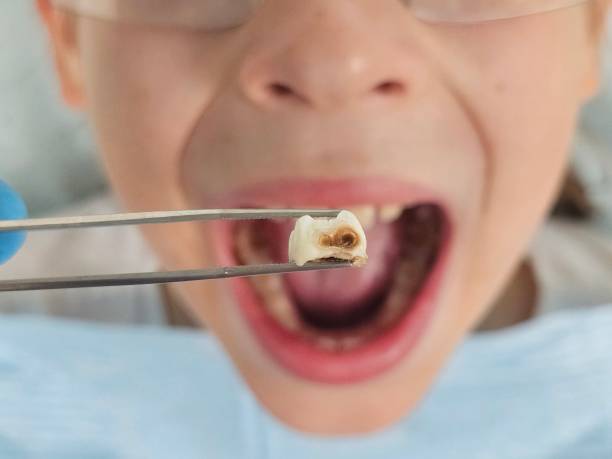 Best Broken or Cracked Tooth Emergency Dentist in Micco, FL